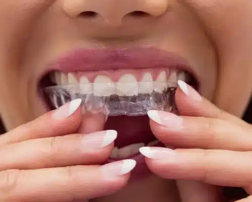 female-patient-wearing-braces