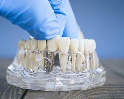side-view-dental-implant-model-with-gloved-hand-adjusting-prosthetic-teeth-transparent-jaw-clinical