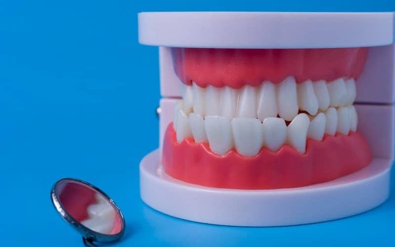 השתלת שיניים בכל הפה